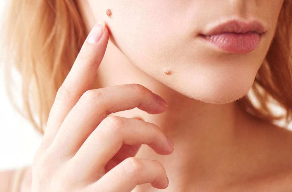 Cosmetic Mole Removal