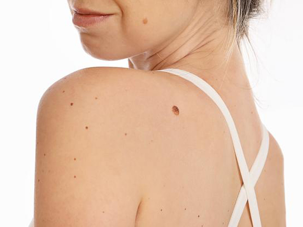 Skin Tag Removal